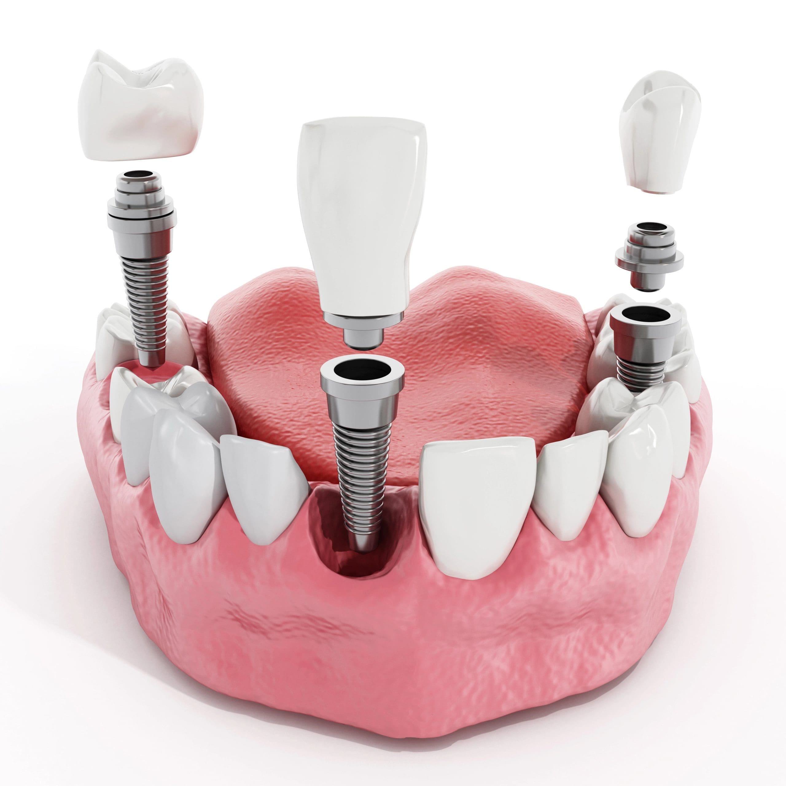 What Are Dental Implants Made Of? Key Materials